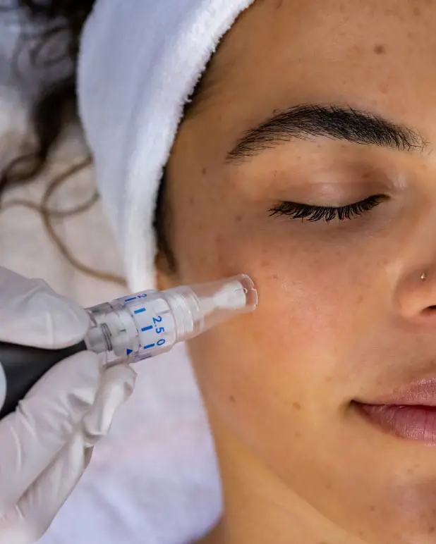 Professional microneedling treatment