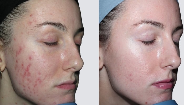 Advanced skin rejuvenation treatment